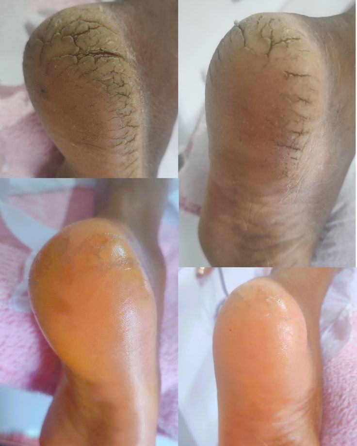 Foot scrub example 2