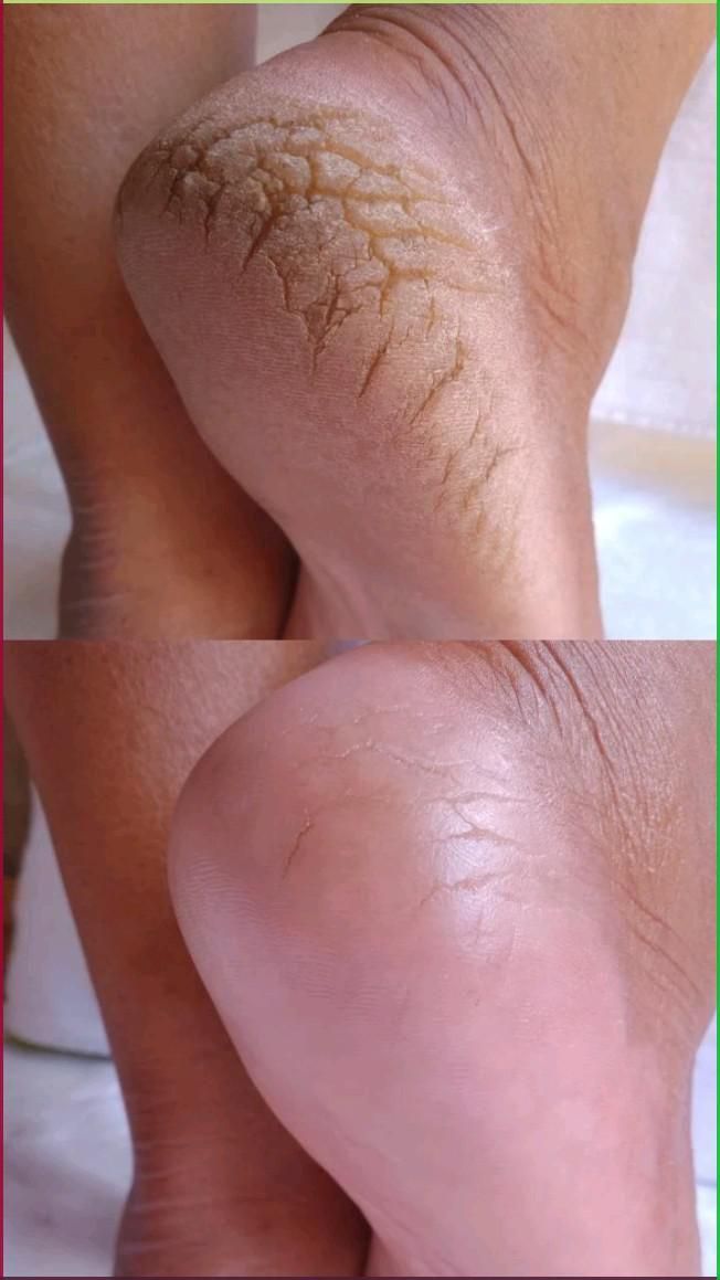 Foot scrub example 3